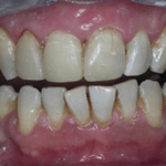 After dental implants - Gipsy Lane Advanced Dental Care
