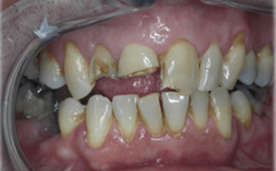 Before dental implants - Gipsy Lane Advanced Dental Care