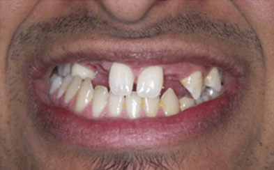 Before dental implants - Gipsy Lane Advanced Dental Care