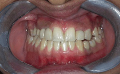 After dental implants - Gipsy Lane Advanced Dental Care 